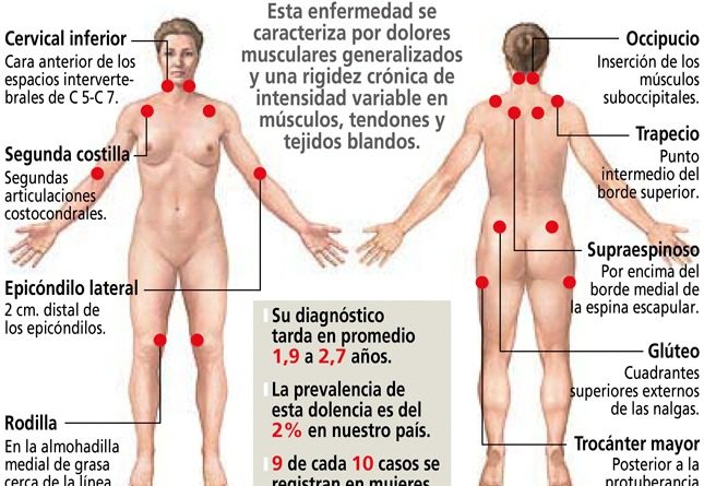 Fibromialgia